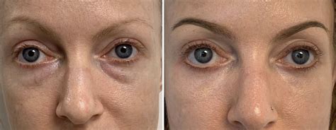 handbags under eyes treatment